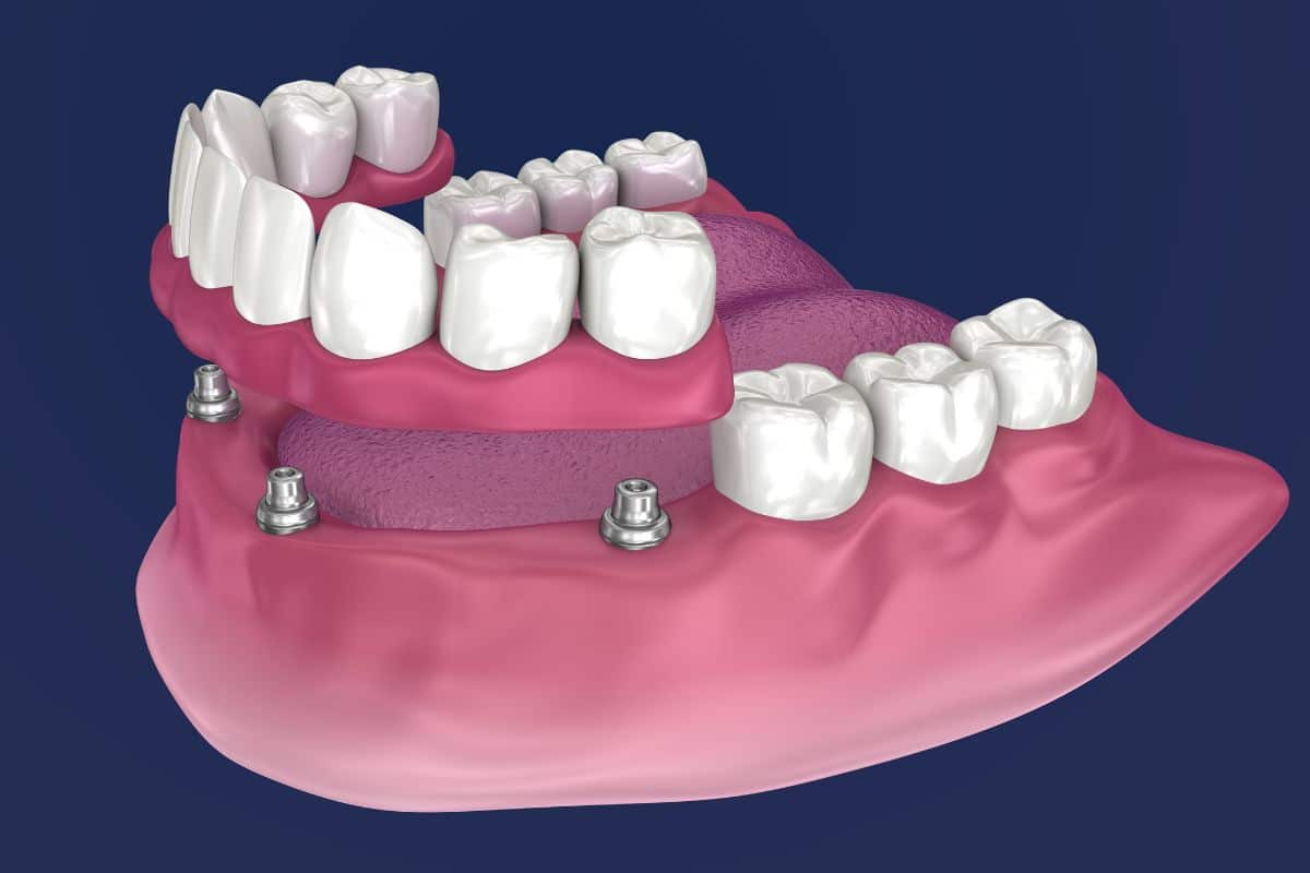 All-on-4 dental implants in Sandy, UT implant dentist sandy