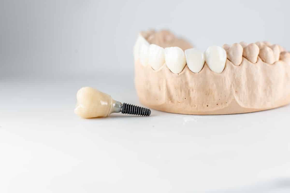 dental implants sandy