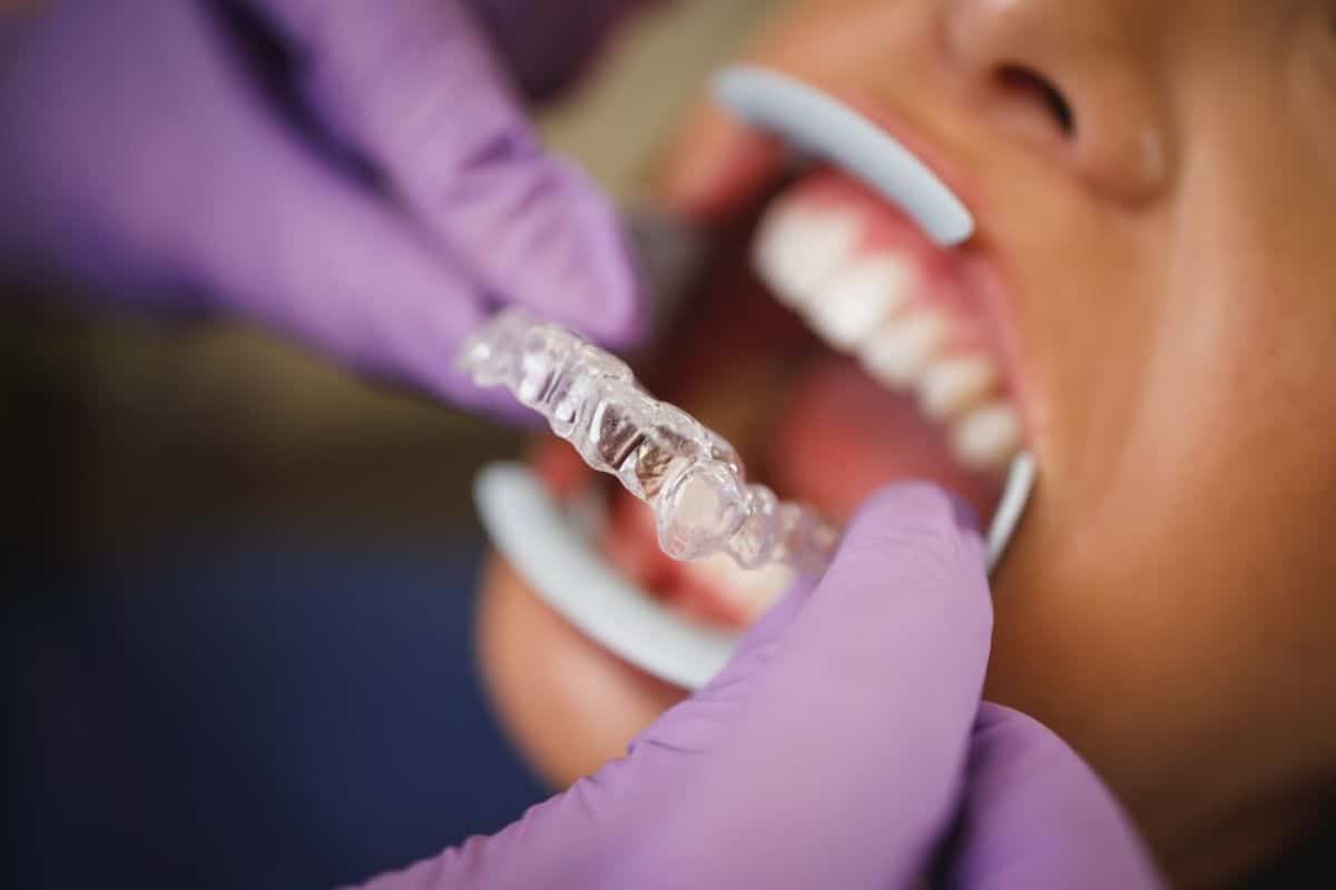 invisalign treatment sandy
