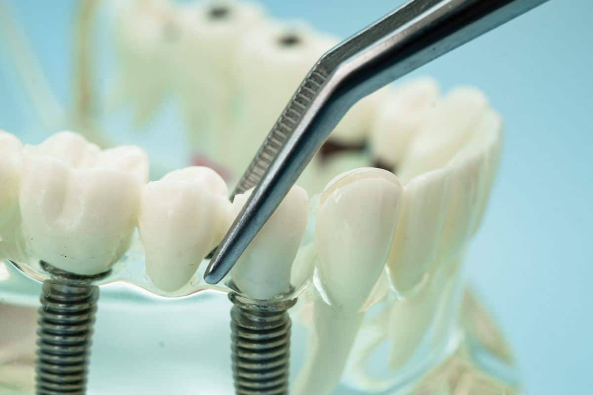 Can One Dental Implant Support Two Teeth (2) dental implants sandy