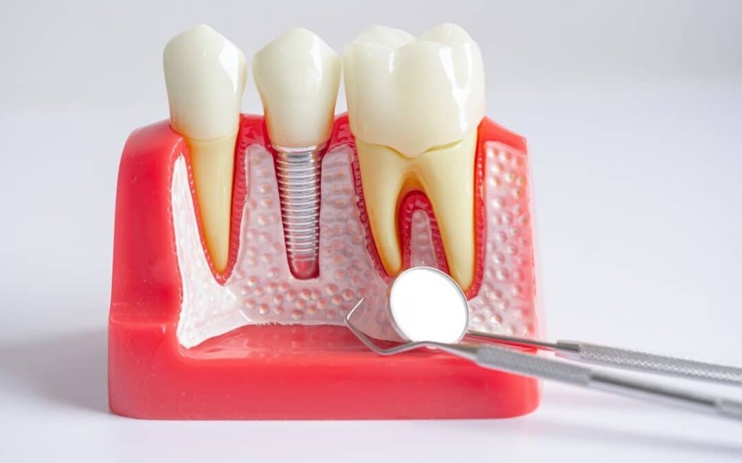 When Do Dental Implants Fail? Key Risk Periods You Should Know