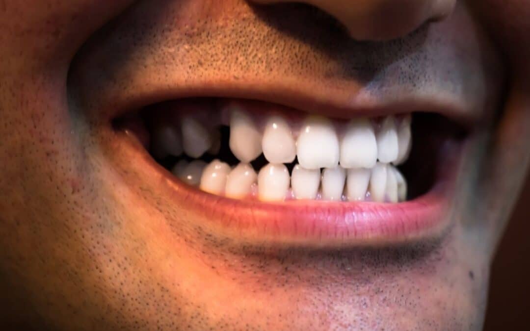 What Is Cosmetic Bonding and How Can It Improve Your Smile?