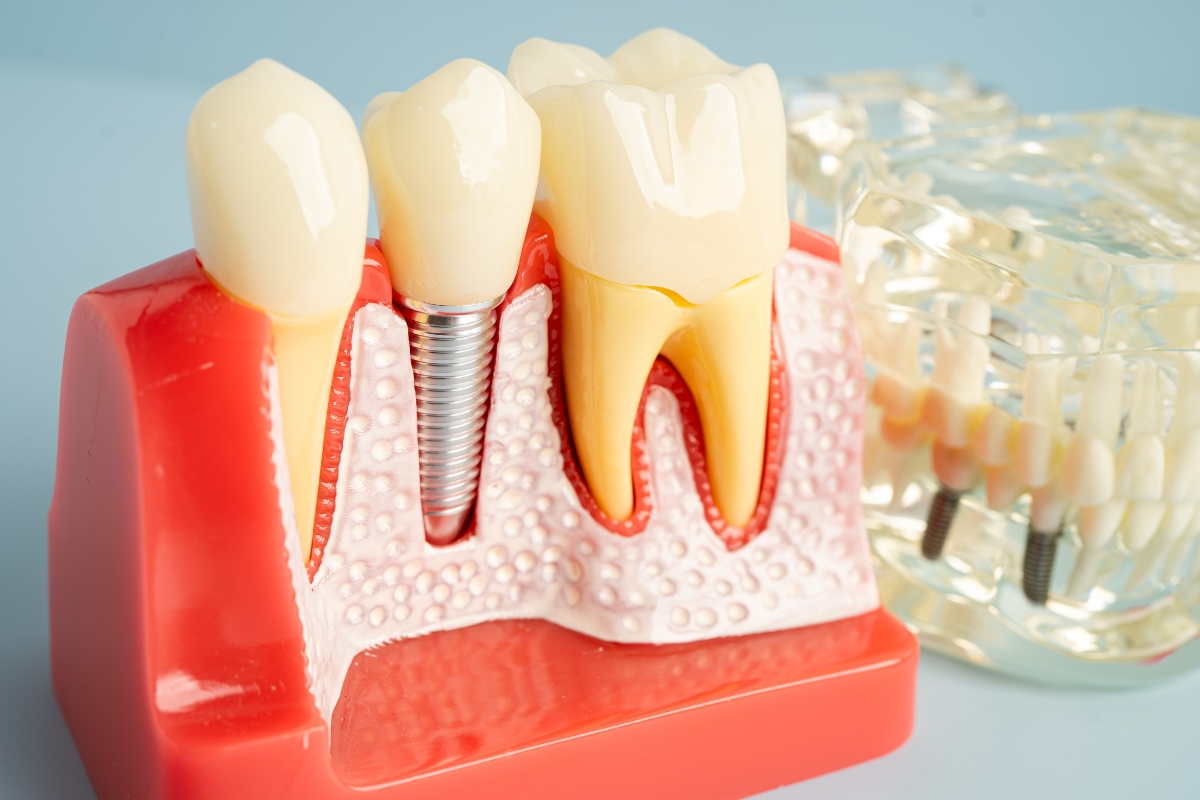 Canyons Family Dental Sandy replace missing teeth with dental implants