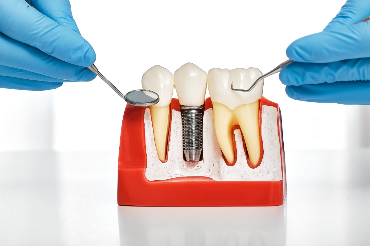 replacing-missing-teeth-with-implants Replacing Missing Teeth with Implants