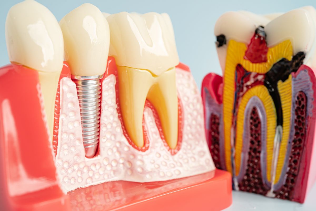 dental implant healing
