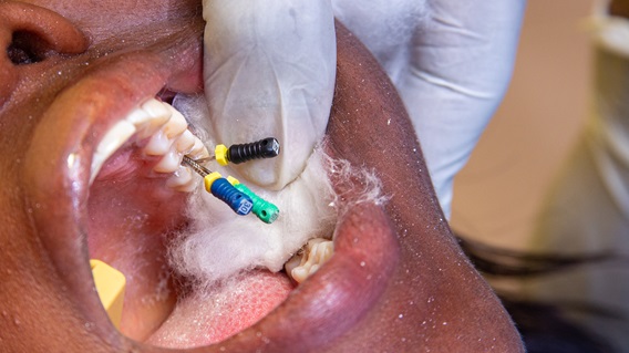Invisalign vs. Braces for Teens: Which Treatment Works Best?