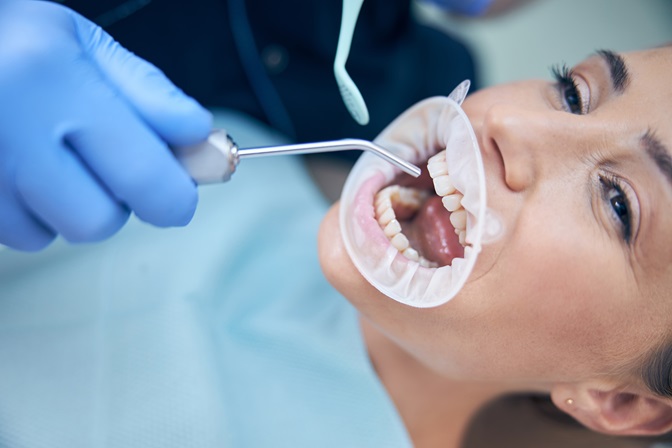 How Dental Sealants Prevent Cavities: A Simple Guide for Patients