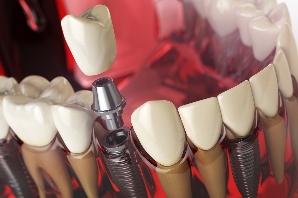 Dental Implants Alexandria