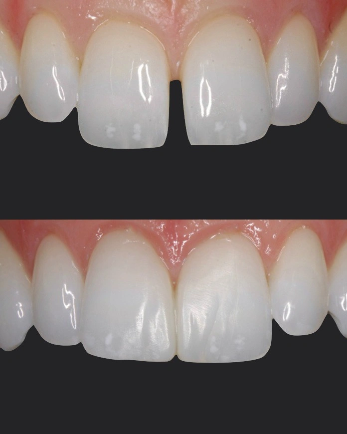 before and after close-up of teeth showing composite dental bonding results