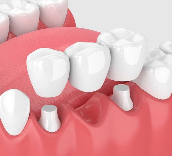 3D illustration of dental bridge placement procedure in alexandria