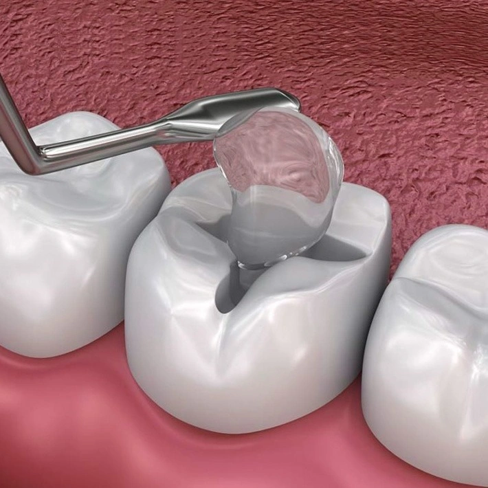 tooth receiving composite dental filling for cavity treatment in alexandria
