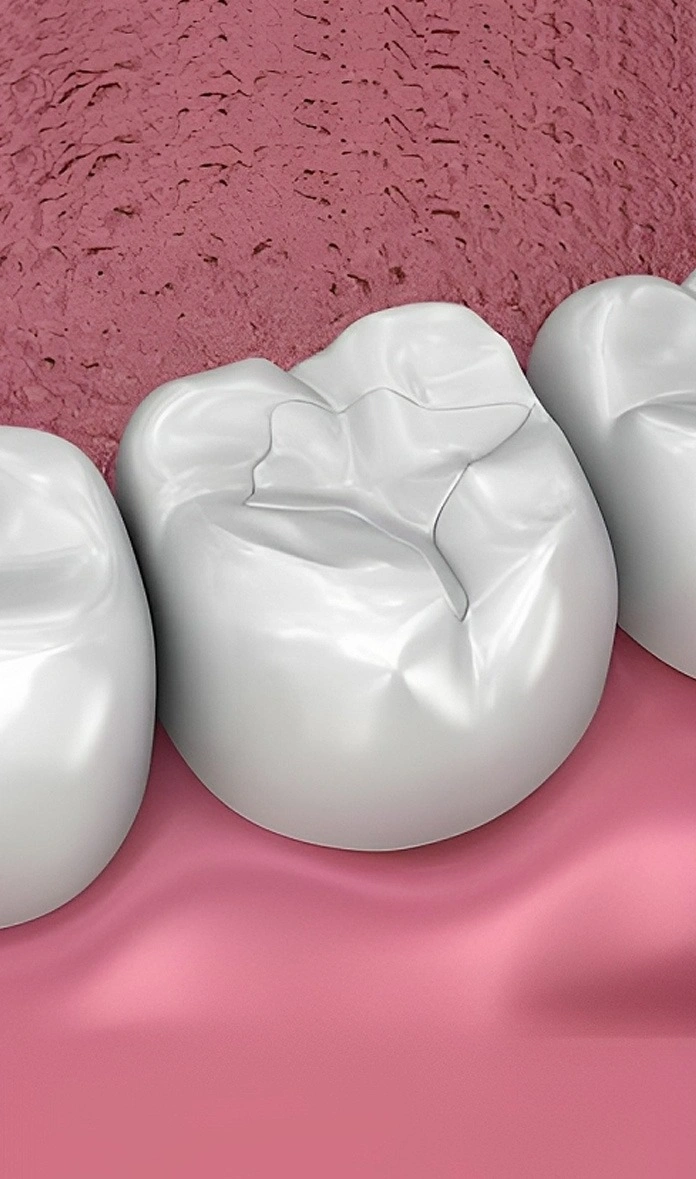 close-up illustration of tooth sealants on molars in alexandria