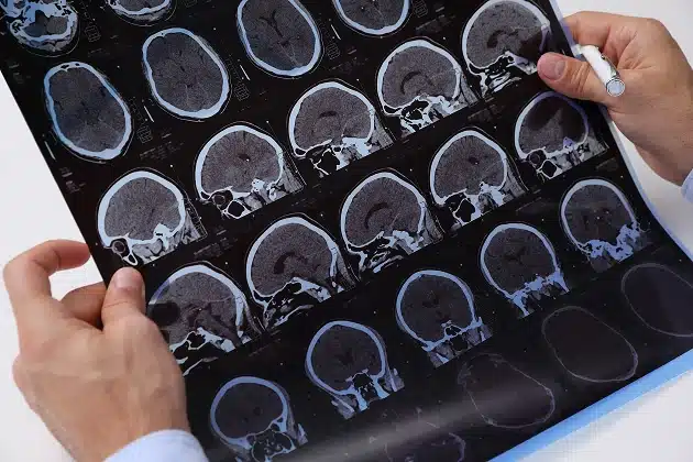 Traumatic Brain Injury Lawyers in Albuquerque