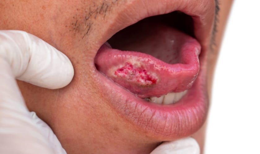 oral cancer screenings coastal dental arts peabody dentist dr peter brzoza dds ficoi