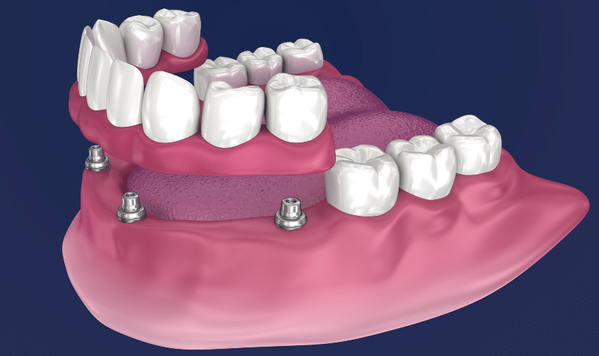 Impact of Full Mouth Implants