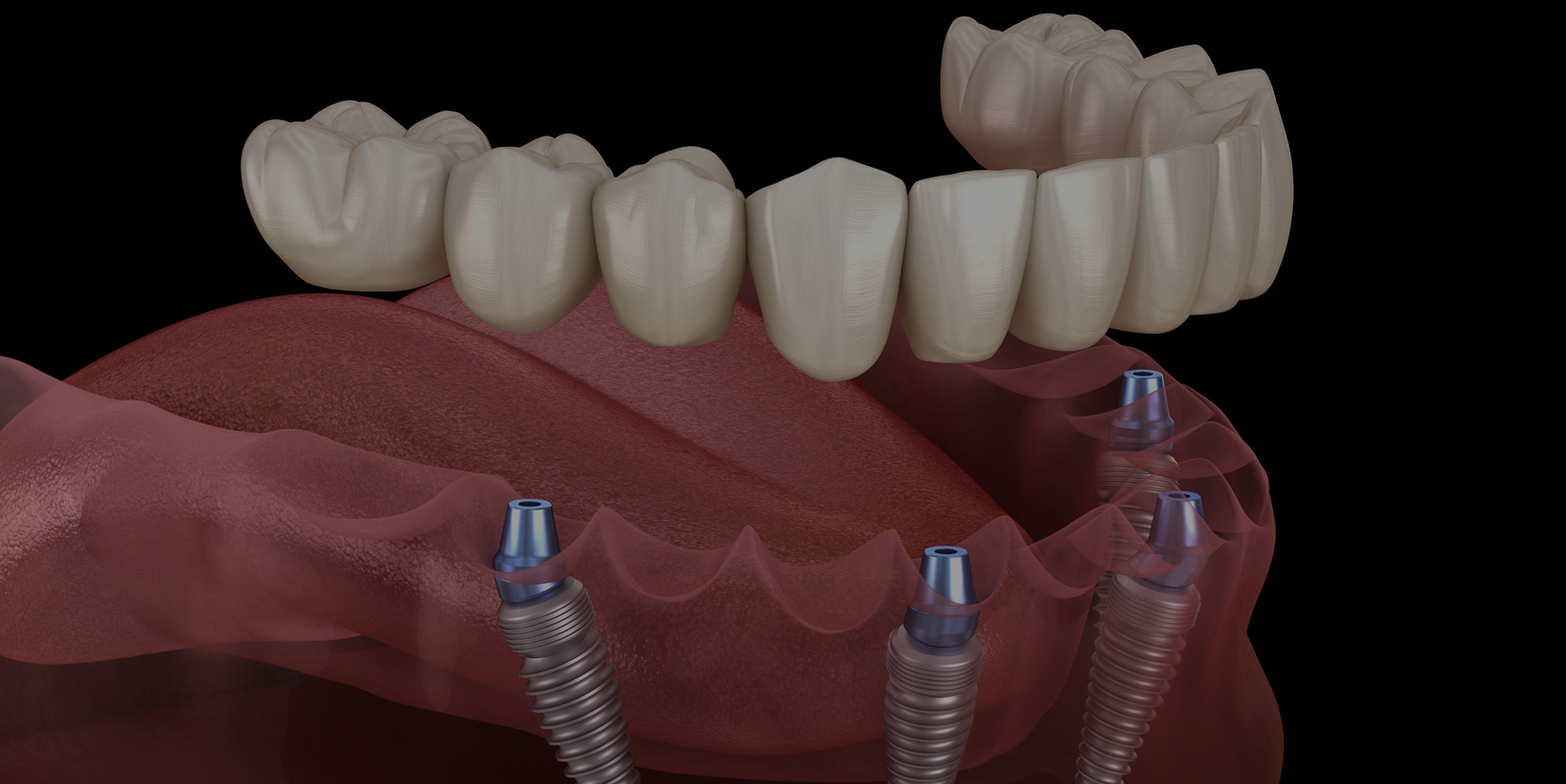 Full Mouth Implant Reconstruction at Coastal Dental Arts in Peabody, MA