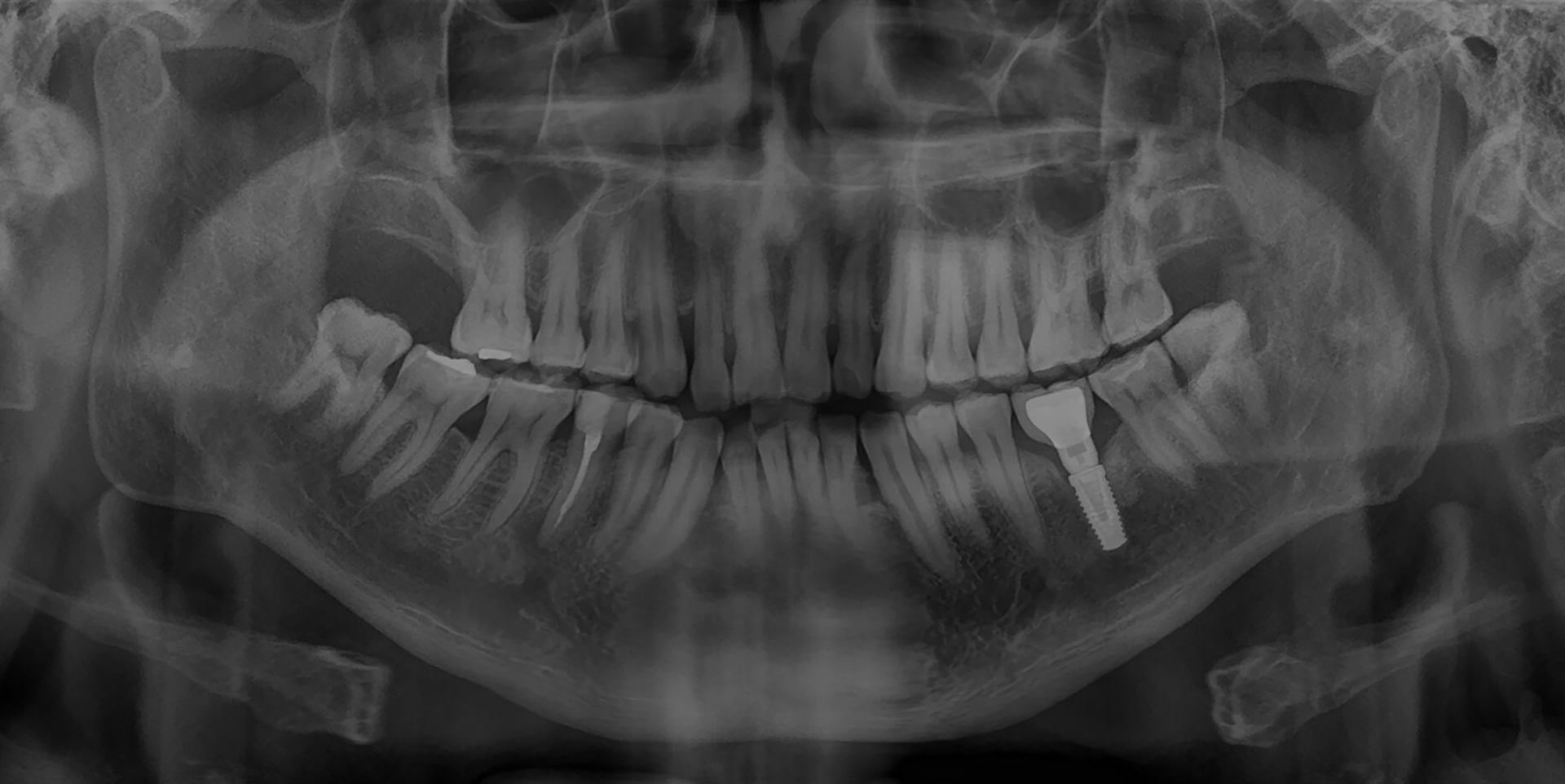 Dental 3D image showing a patient’s teeth before dental implant surgery at Coastal Dental Arts in Peabody, MA