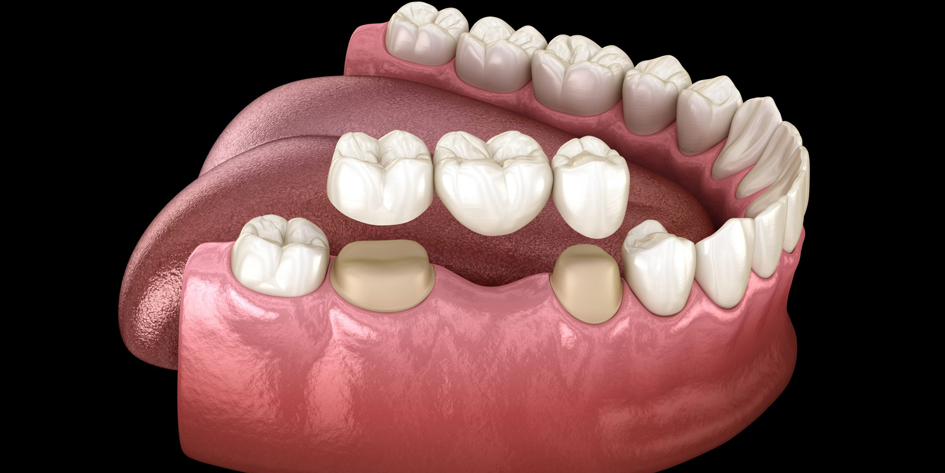 Replace missing teeth with dental bridges at Coastal Dental Arts in Peabody, MA.