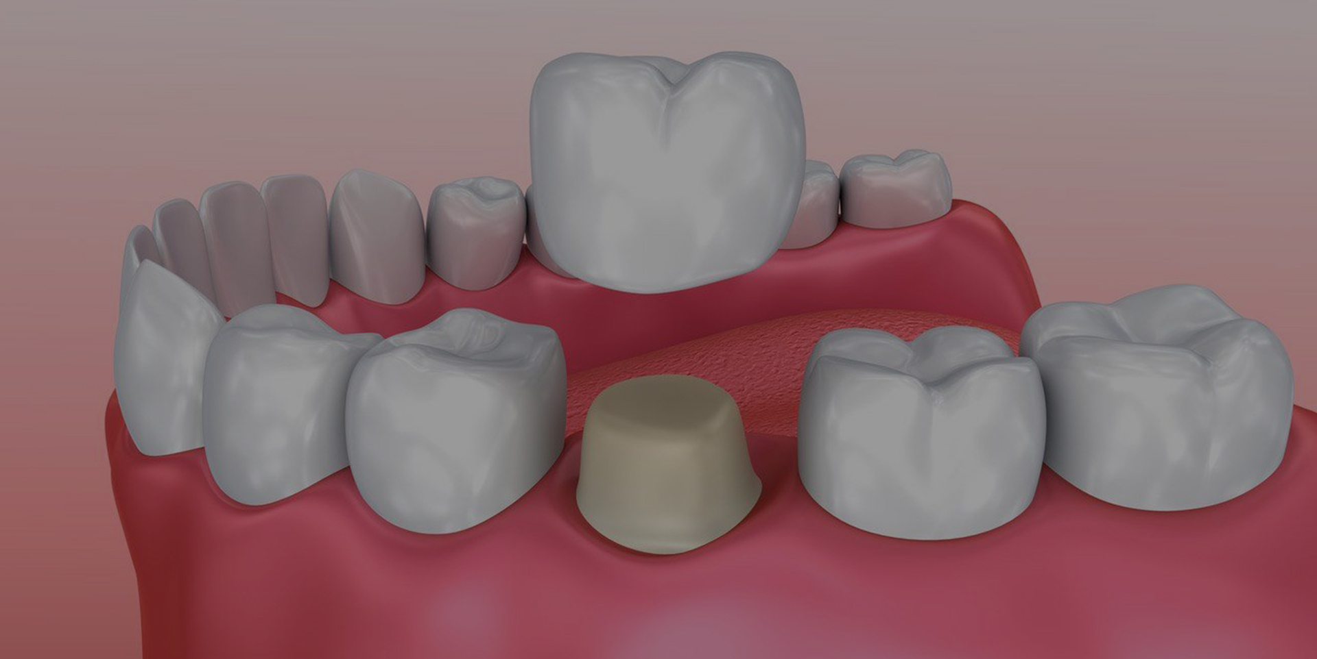 Same-day CEREC dental crowns at Coastal Dental Arts in Peabody, MA
