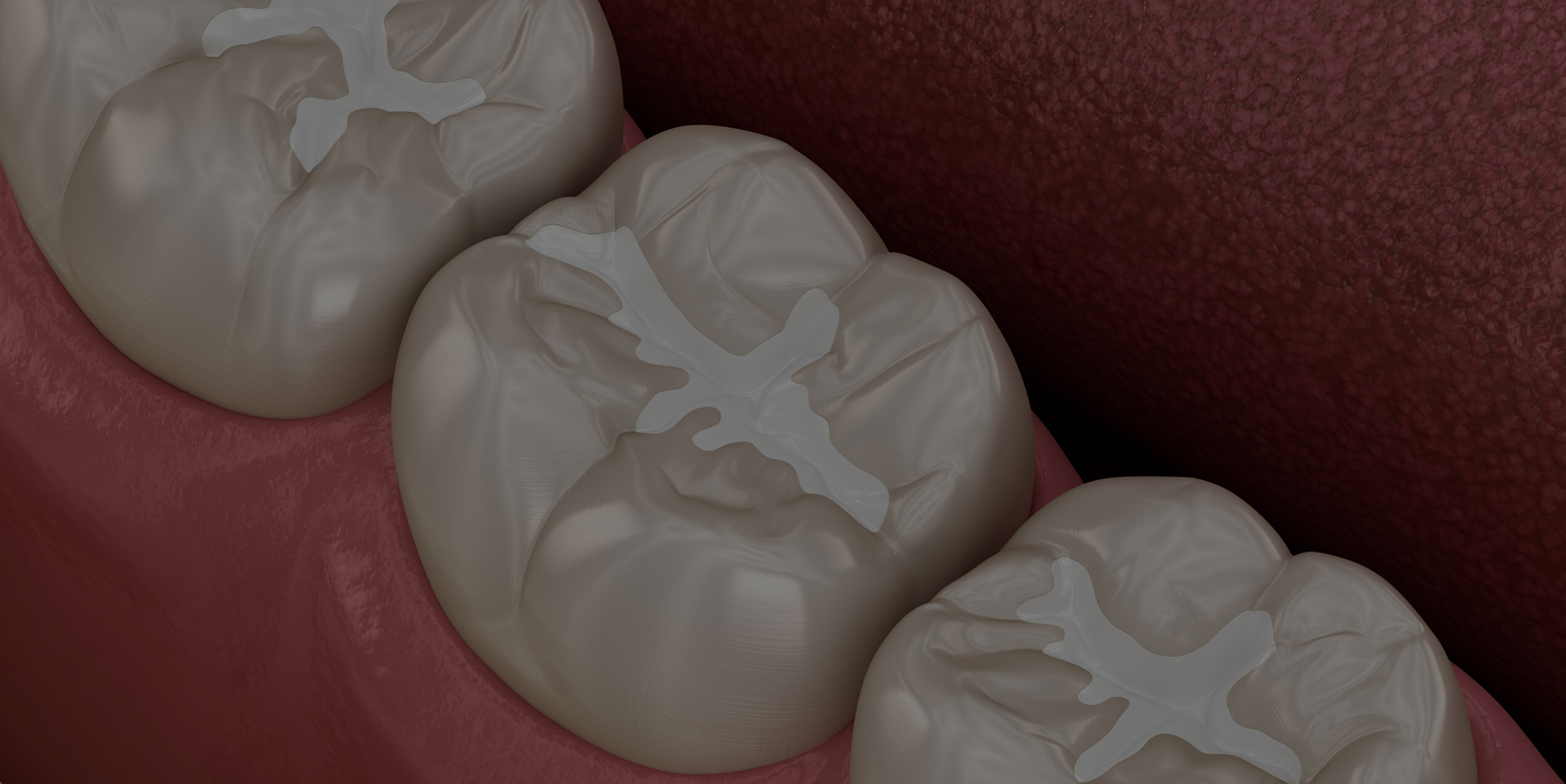 Protect your teeth from cavities with composite resin fillings at Coastal Dental Arts in Peabody, MA