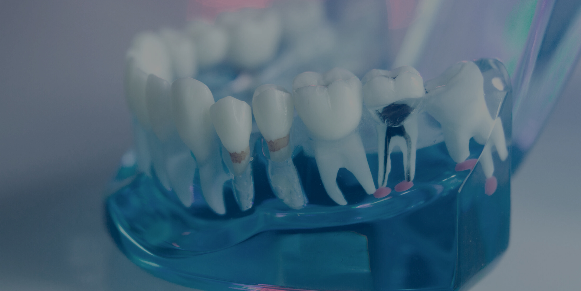 Root canal treatment at Coastal Dental Arts in Peabody, MA. The image showing a decayed tooth