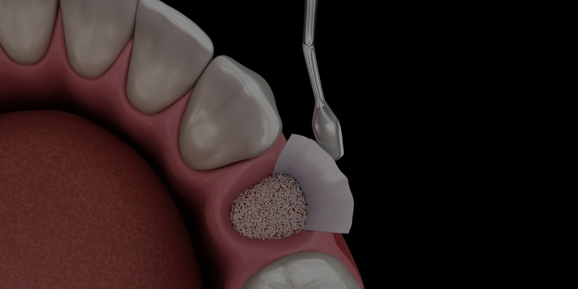 Bone grafting at Coastal Dental Arts in Peabody, MA