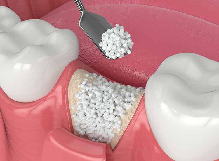 Bone Graft in Peabody, MA