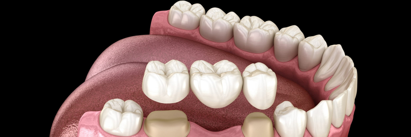 Dental Bridges and crown