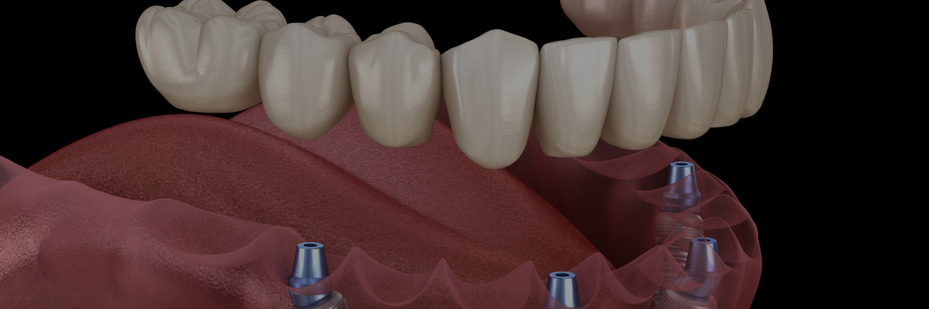 Full Mouth Implant Reconstruction