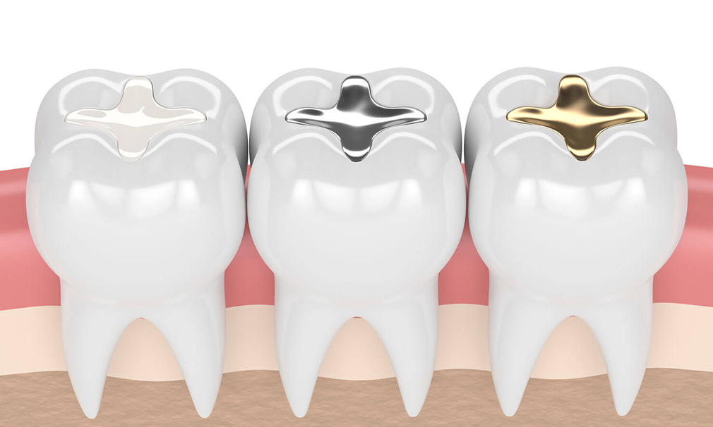 Dental fillings at Coastal Dental Arts in Peabody, MA