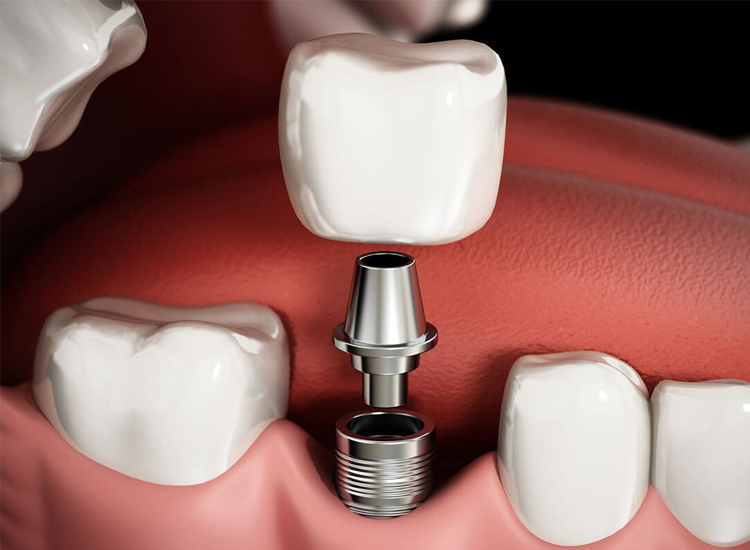 Dental implants Peabody, MA at Coastal Dental Arts