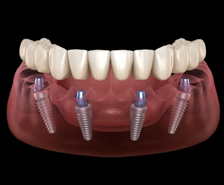 Full mouth implant reconstruction at Coastal Dental Arts in Peabody, MA