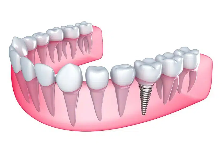 single dental implant peabody