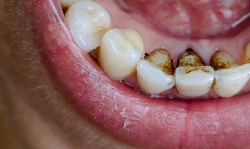 how do you get tobacco stains off dentures How to Remove Nicotine Stains from Teeth
