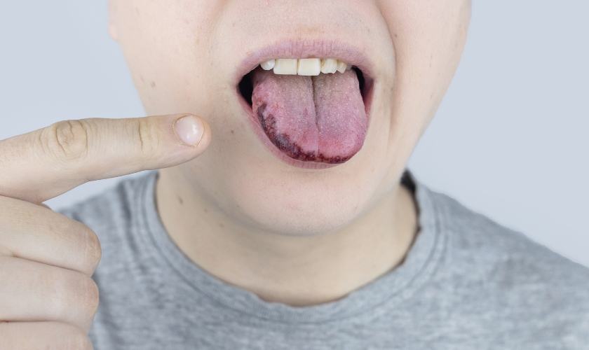 vitamin deficiency causes black spots on the tongue