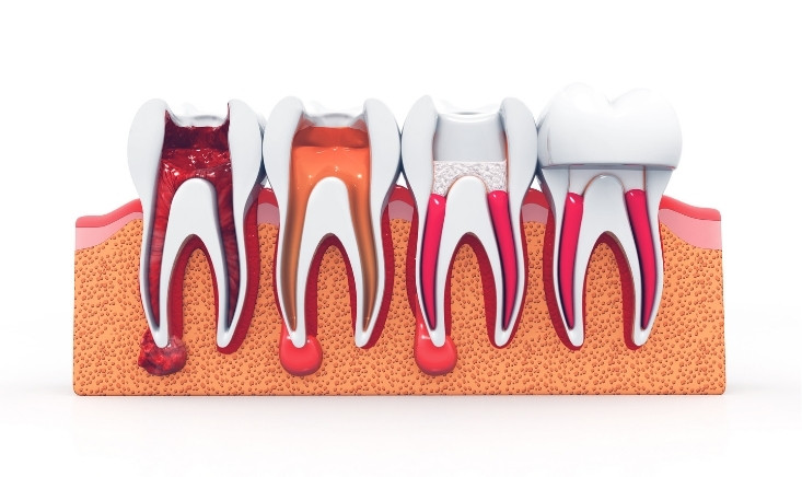 prevent the need for a root canal