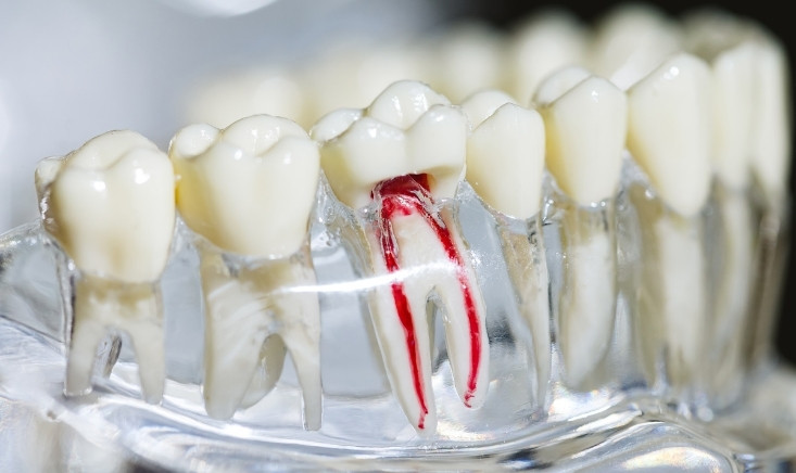 what to eat and what to avoid after root canal therapy