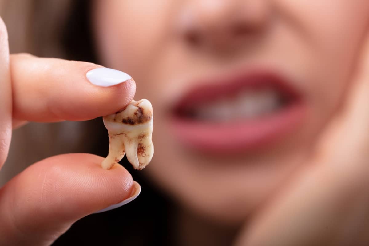 Tooth Decay
