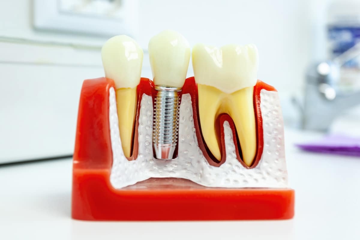dental implants in Fort Worth