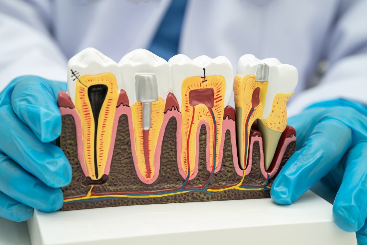 Dental Implants Fort Worth