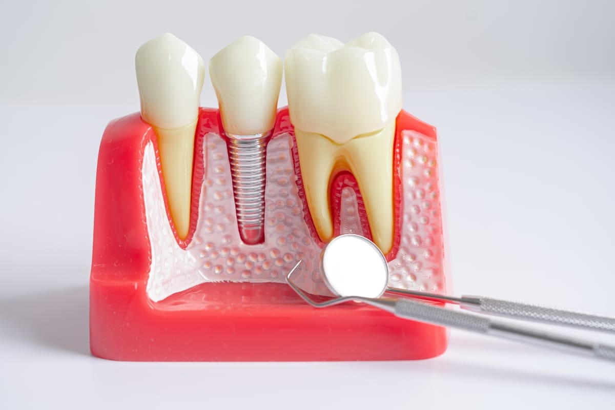dental implants Fort Worth