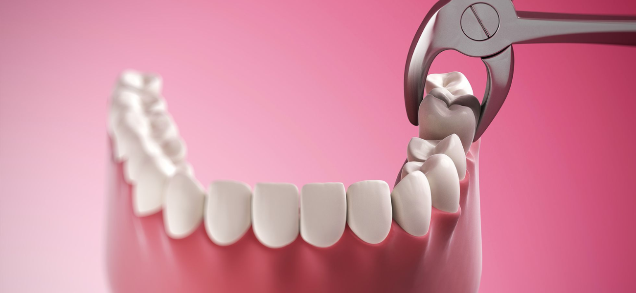 Tooth Extraction Necessary