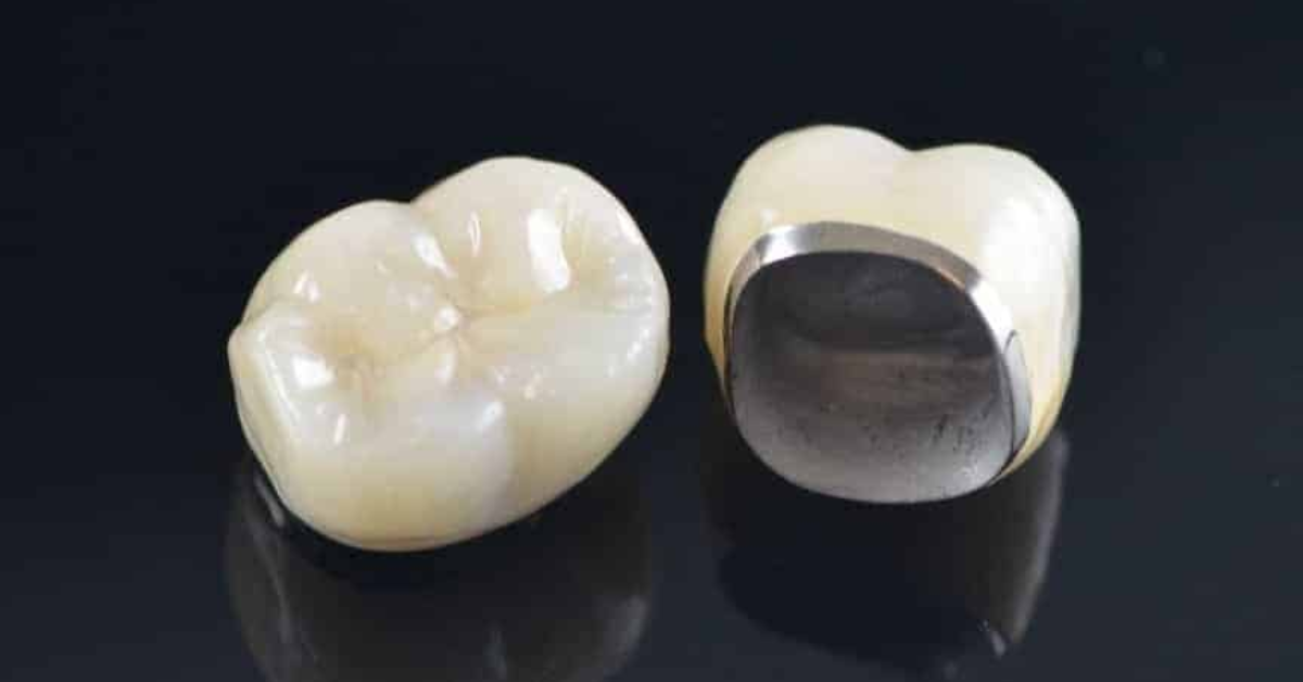 Ceramic or Porcelain Crowns