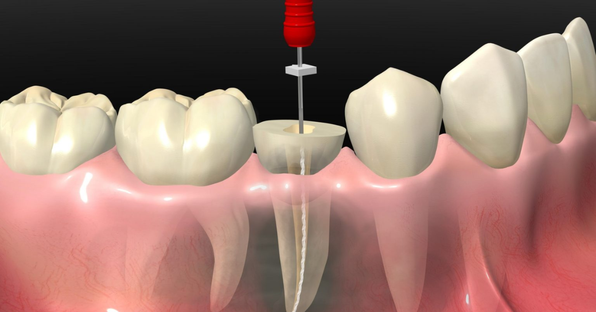 Root Canal