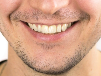 Dental veneers smile after treatment