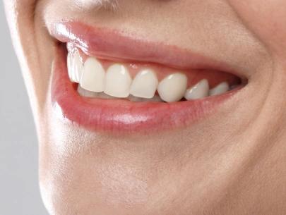 Cosmetic dentistry smile after treatment