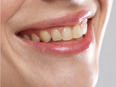 Cosmetic dentistry smile before treatment