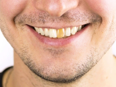Dental veneers smile before treatment
