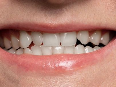 Teeth whitening smile after treatment