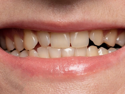 Teeth whitening smile before treatment